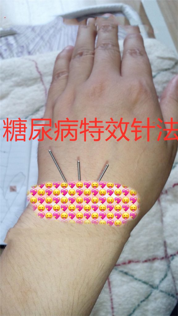 糖尿病特效针法和秘方